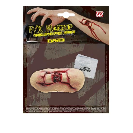 Fractura de hueso Fractura de hueso